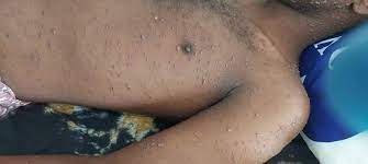 Dad la xanuunsan Cudurka Bus-buska oo la dhigay isbitaalada  Baladweyne